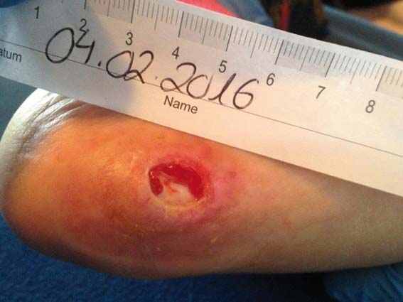 Fig. 1: 04.02.2016: decubitus grade 2 on the right heel / sole. Condition after wound cleaning with LIGASANO® Wundputzer® (wound cleaning sponge) intensive